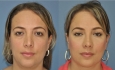 Revision rhinoplasty (correction of a previously operated nose by other surgeon)